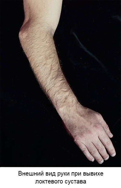 внешний вид руки при вывихе локтевого сустава