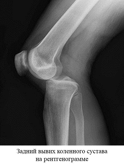 рентгеновский снимок при заднем вывихе коленного сустава