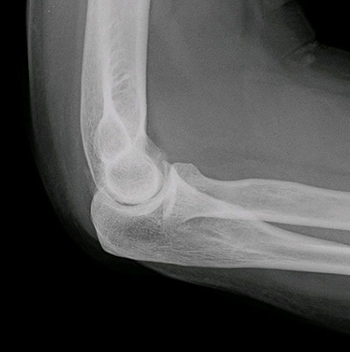 рентген локтевого сустава, пораженного артрозом