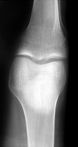рентгеновский снимок кости, пораженной диффузным остеопорозом