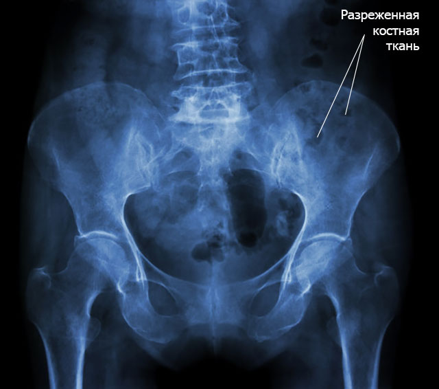 рентген кости с остеопорозом