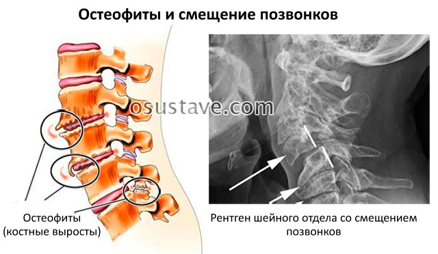 костные остеофиты и смещение позвонков на рентгене