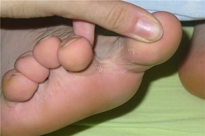 Особенности лечения грибка между пальцами ног