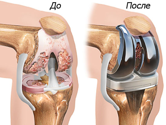поврежденный сустав и его протезирование