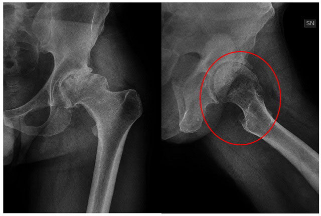 рентгеновский снимок здорового сустава и пораженного артропатией