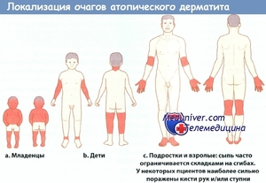 Детский атопический дерматит