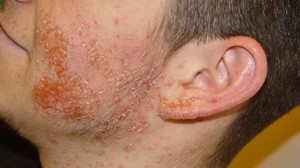 Описание заболевания кожи сухой стрептодермии