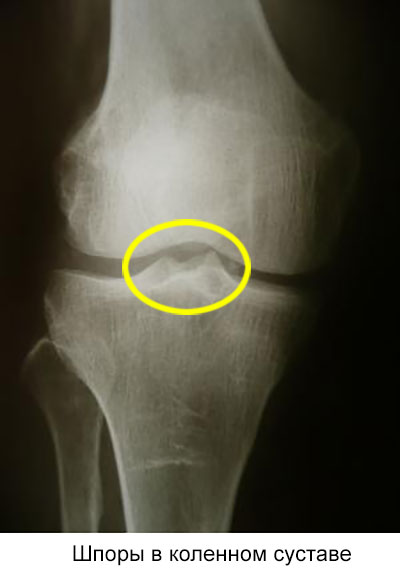 шпоры в коленном суставе на рентгене