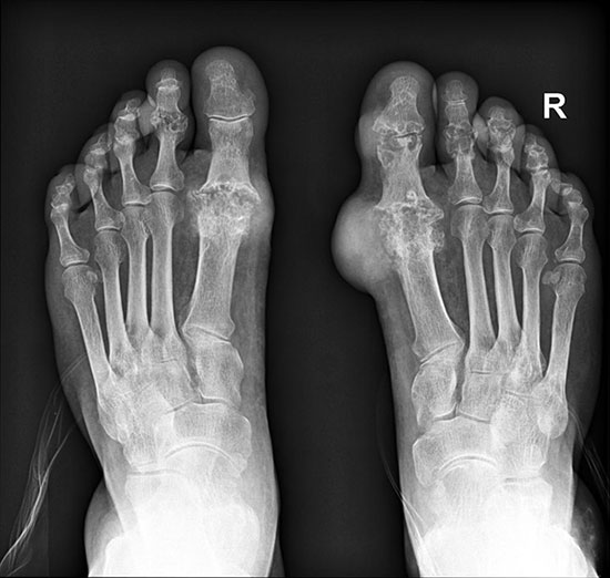 рентгеновский снимок, подагра на правой ноге