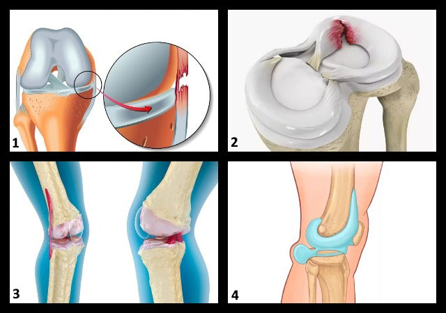 патологии коленного сустава, которые можно увидеть на МРТ