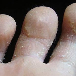 Грибок между пальцами ног