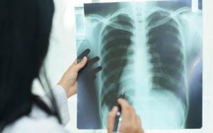 Рентгеновский снимок лёгких