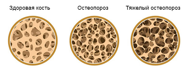 изменения в кости при остеопорозе