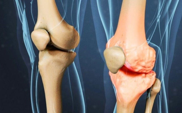 здоровый коленный сустав и с остеофитами