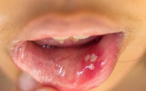 Рот, поражённый вирусом папилломы человека