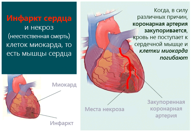 obshirnyj-infarkt-miokarda