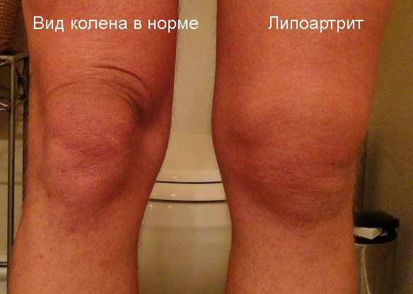 внешний вид колена в норме и при липоартрите