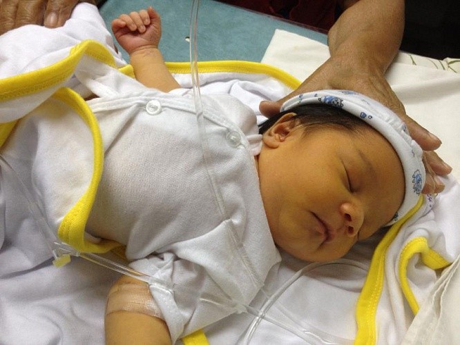 Синдром физиологической желтухи новорожденных 