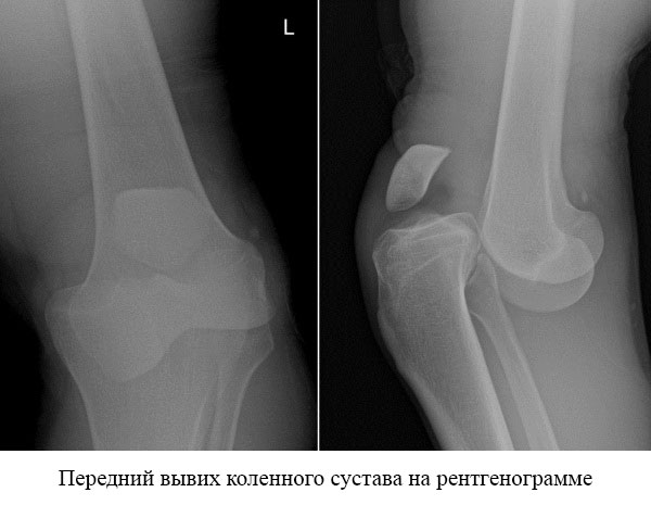рентгеновский снимок при переднем вывихе коленного сустава