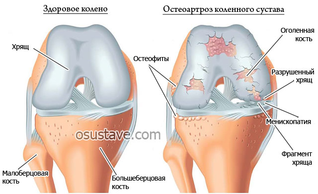 остеоартроз колена