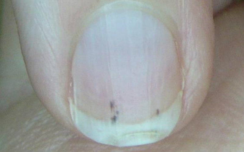 Как псориатический артрит влияет на ногти?