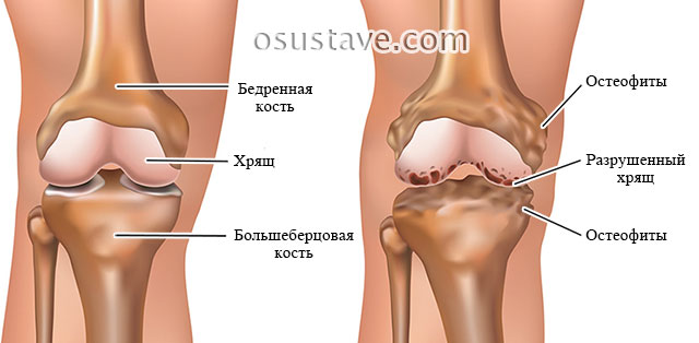 норма и остеоартроз коленного сустава