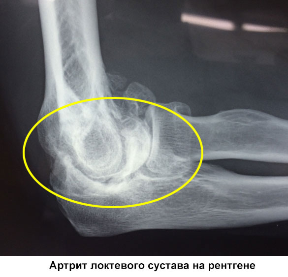 артрит локтевого сустава на рентгене
