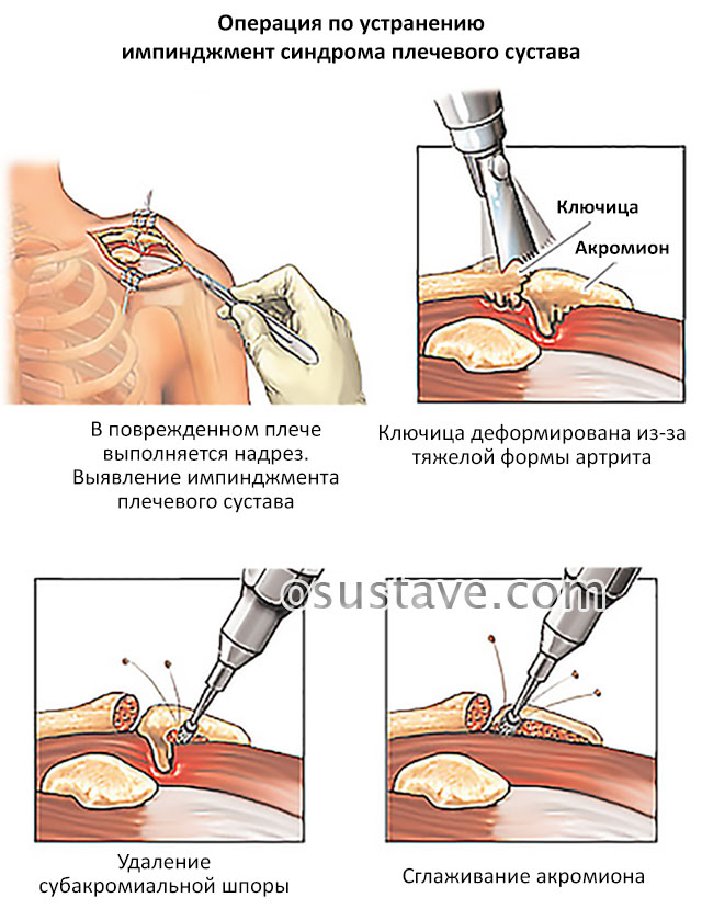 операция при импинджмент-синдроме плечевого сустава