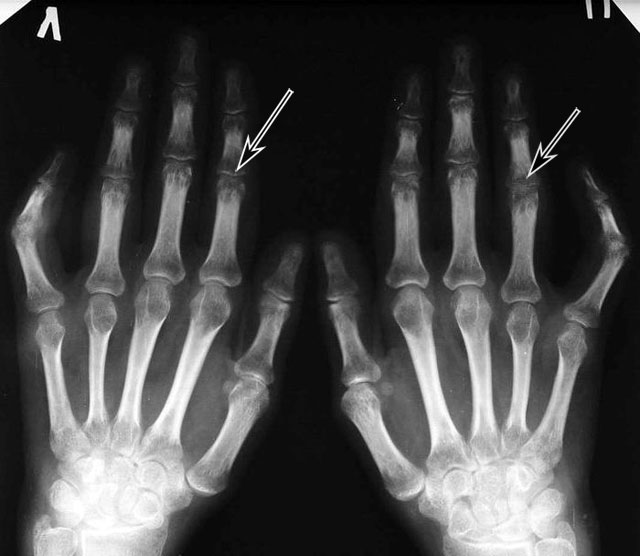 рентгенограмма артроз пальцев рук 2 стадии