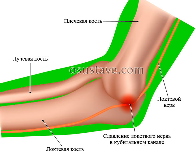 компрессия локтевого нерва в кубитальном канале