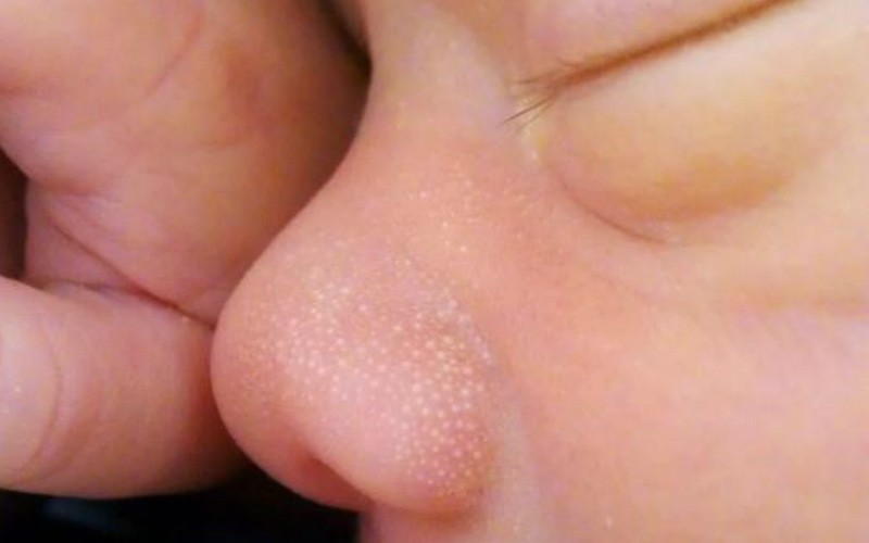 Что вызывает сыпь на лице у ребёнка?