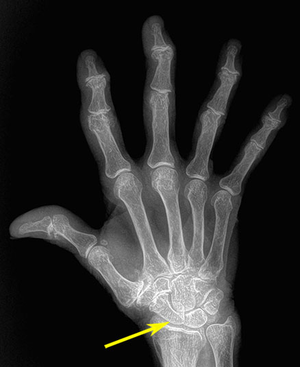рентген лучезапястного сустава с артрозом