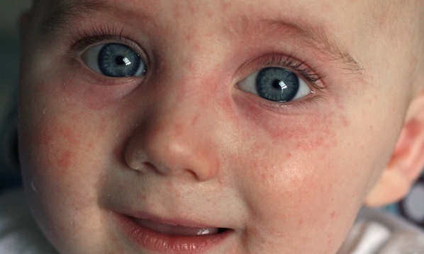 фото ребенка с аллергией на мясо