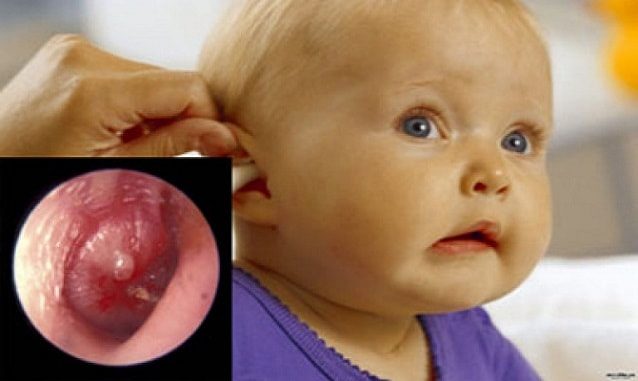 Отит среднего уха симптомы и лечение у детей