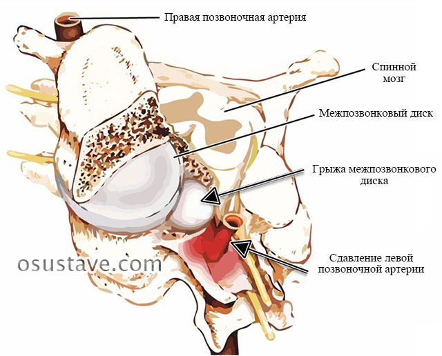 сдавление левой позвоночной артерии грыжей межпозвонкового диска
