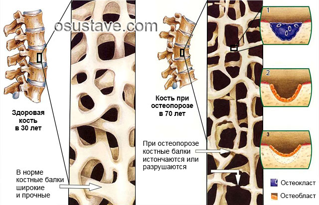 изменение в костях при остеопорозе