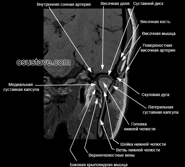 магнитно-резонансная томография височно-нижнечелюстного сустава