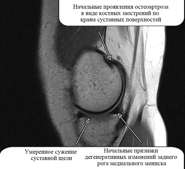 МР-картина остеоартроза коленного сустава
