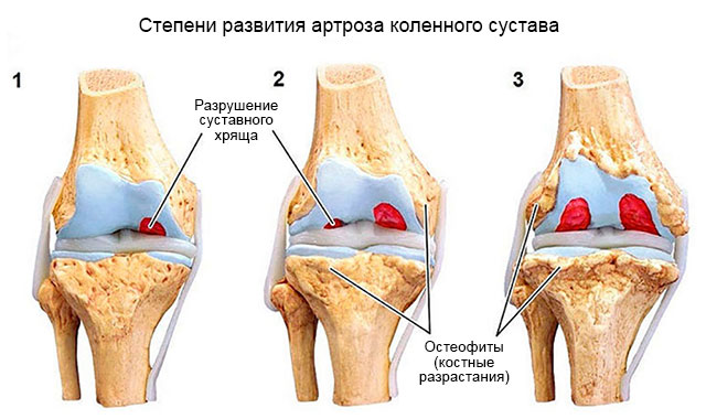 степени артроза коленного сустава