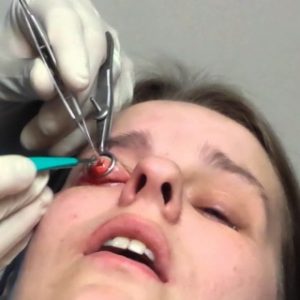Удаление ячменя на глазу хирургическим