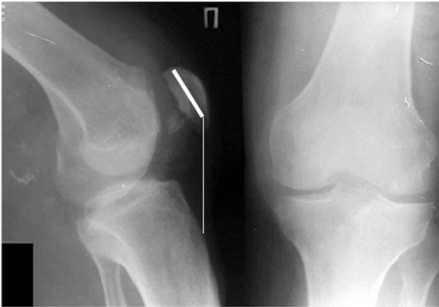 рентгенограмма при переломе надколенника