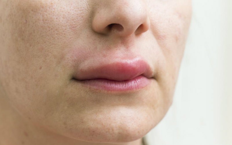 Бугорки на губах. Причины и лечение