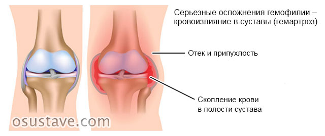 гемартроз коленного сустава