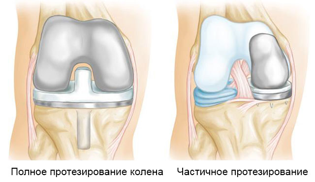 полное и частичное протезирование коленного сустава