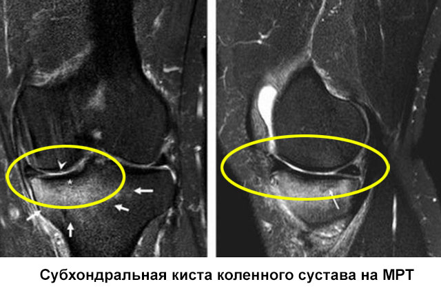субхондральная киста коленного сустава на МРТ