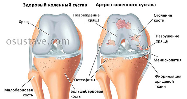 нормальный коленный сустав и артроз колена
