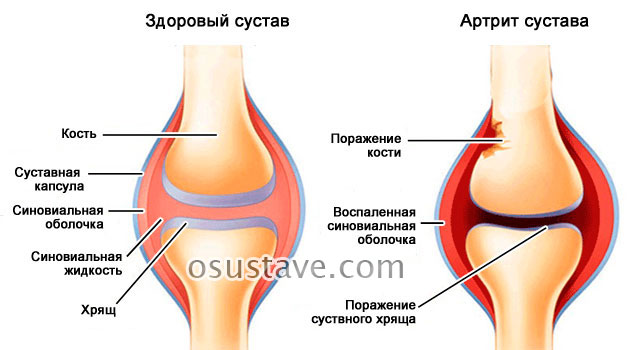 артрит сустава
