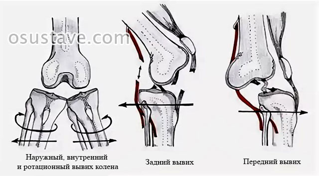 наружный, внутренний, ротационный, задний и передний вывихи коленного сустава