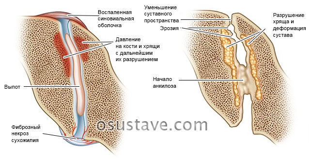 механизм развития ревматоидного артрита, поражение сустава пальца руки