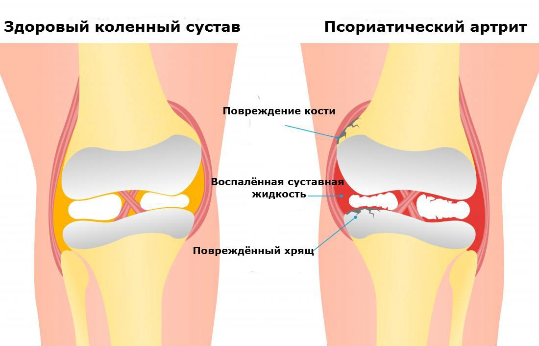 Псориатический артрит коленного сустава. Причины, симптомы, лечение